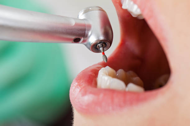 Best Broken or Cracked Tooth Emergency Dentist in Stirling, NJ